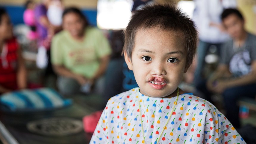 Een Filipijns meisje voor de operatie van haar hazenlip